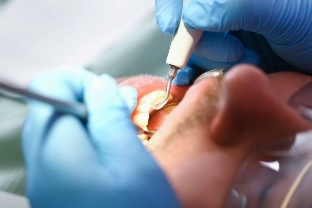 Best Emergency Wisdom Tooth Extraction in Marksville, LA