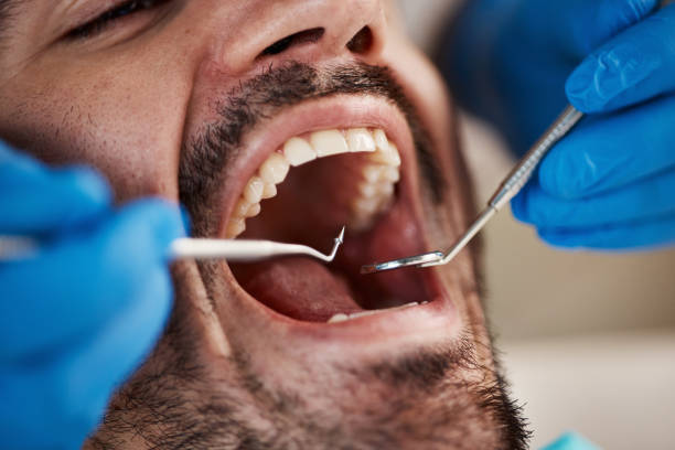 Best Dental Abscess Treatment in Marksville, LA